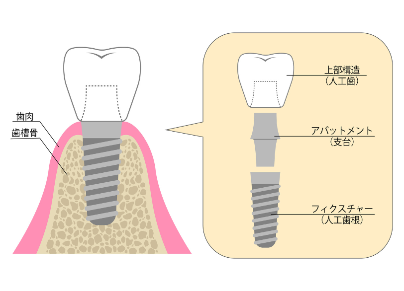 インプラントの構造｜おひさま歯科