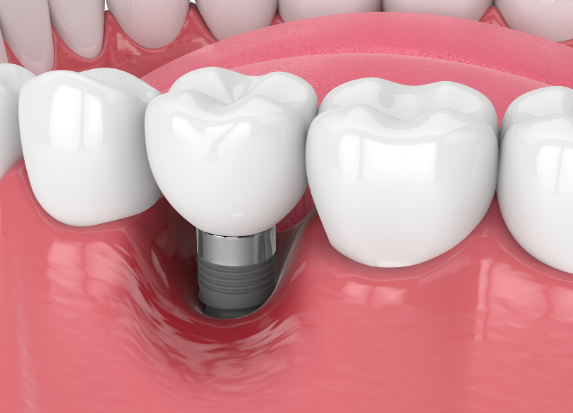 インプラント周囲炎｜おひさま歯科