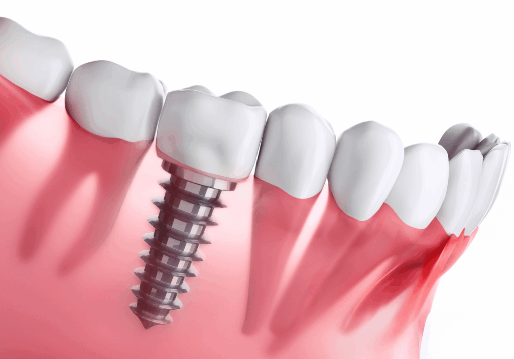 5年保証｜おひさま歯科