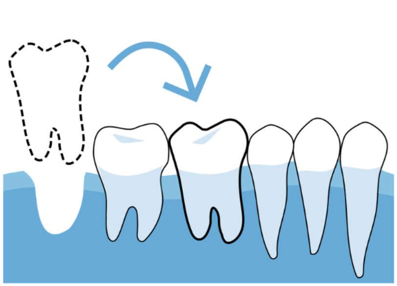 自家歯牙移植｜おひさま歯科