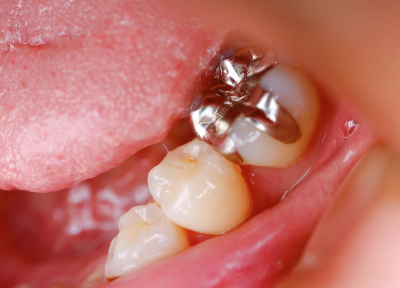 詰め物｜おひさま歯科