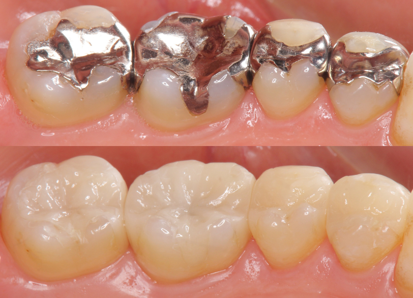 補綴治療｜おひさま歯科