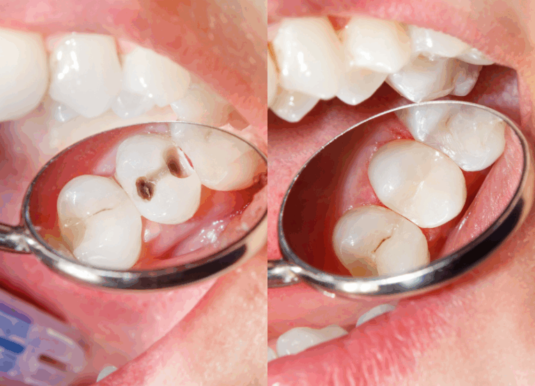 コンポジットレジン｜おひさま歯科