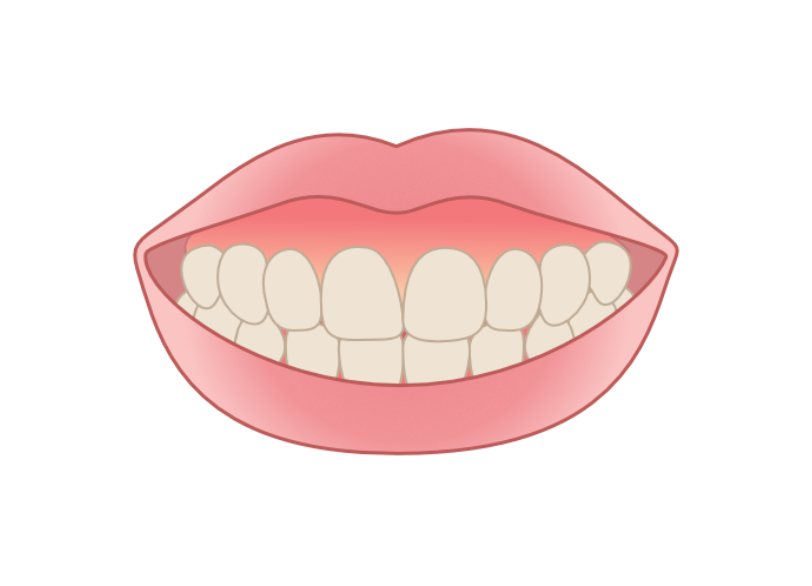 ガミースマイル｜おひさま歯科