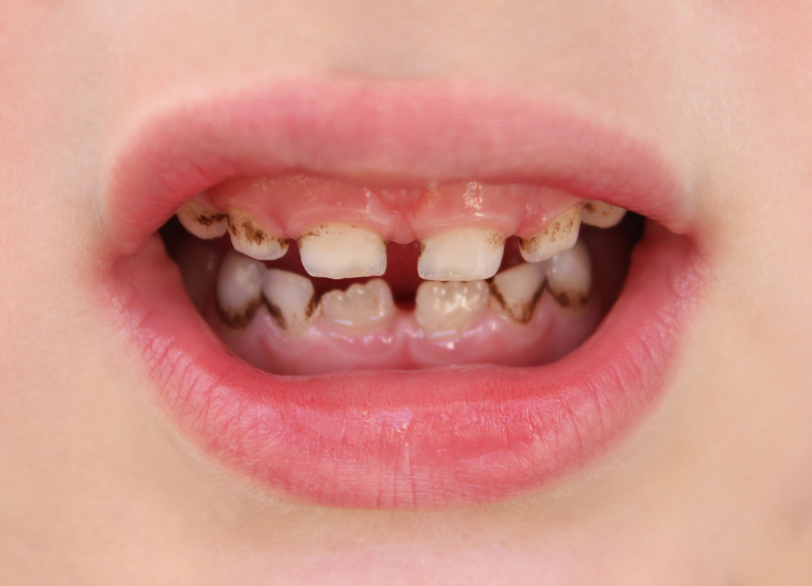 子どもの虫歯｜おひさま歯科