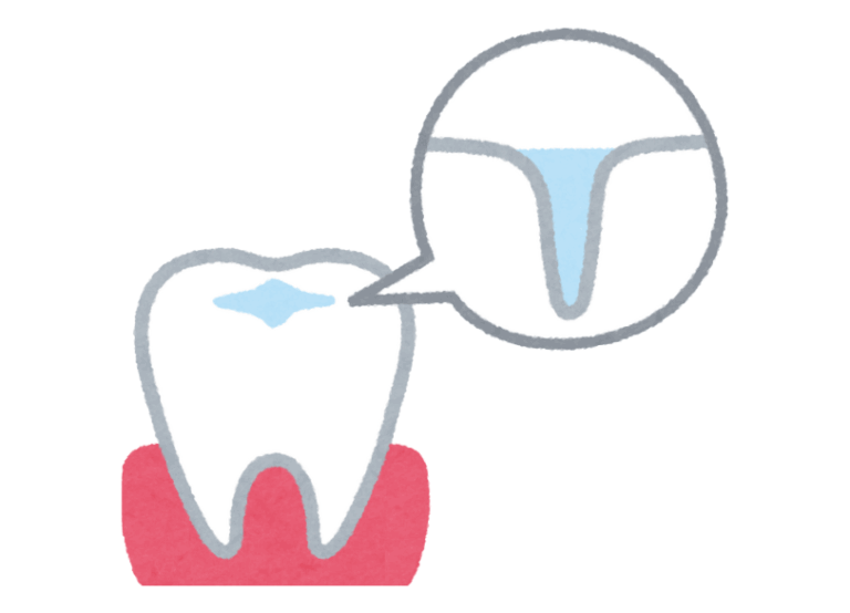 シーラント｜おひさま歯科