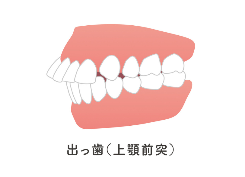 出っ歯｜おひさま歯科