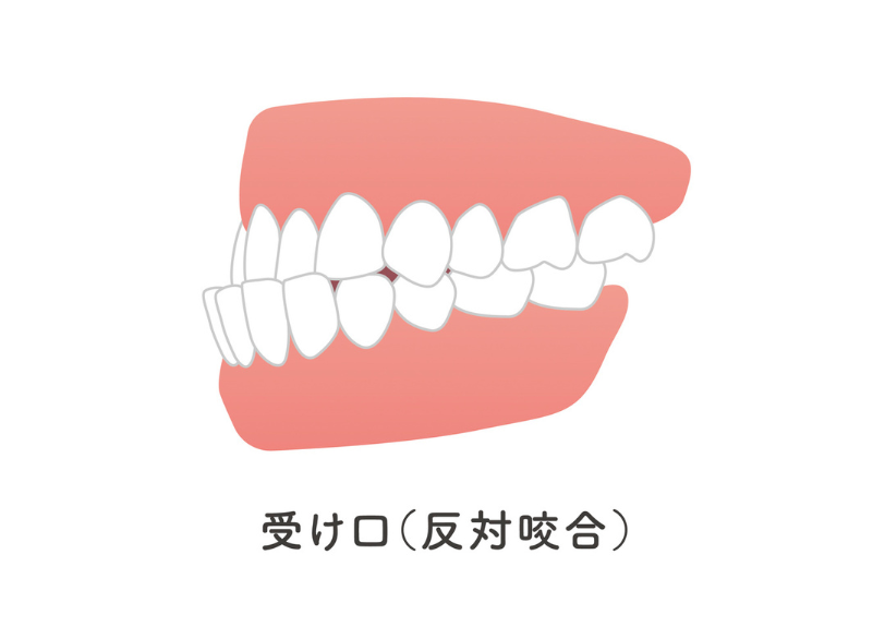 反対咬合｜おひさま歯科