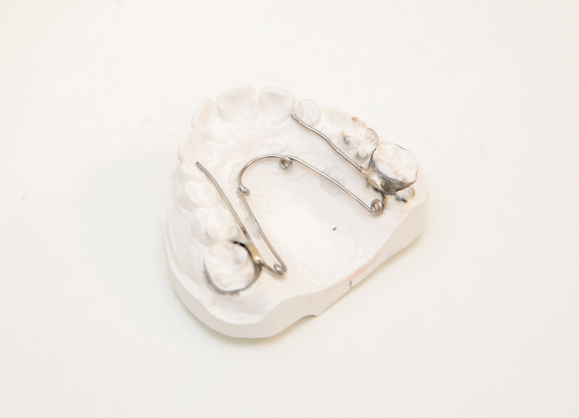 スペースメインテナー｜おひさま歯科