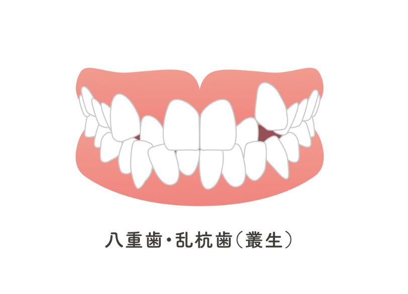 叢生｜おひさま歯科