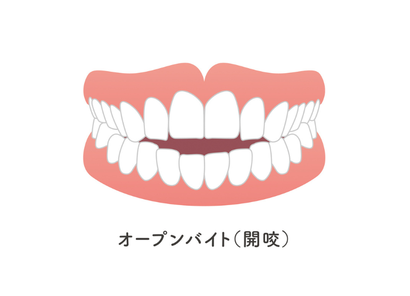 開咬｜おひさま歯科