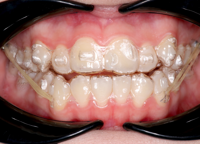 アタッチメント｜おひさま歯科