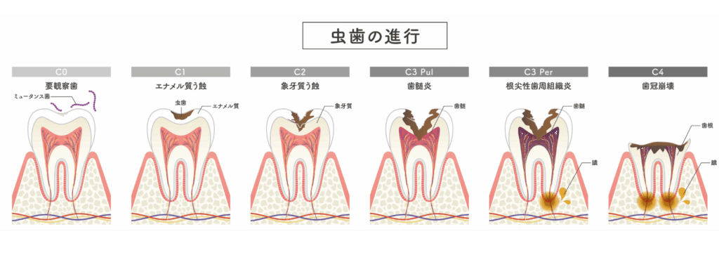 虫歯の進行｜おひさま歯科
