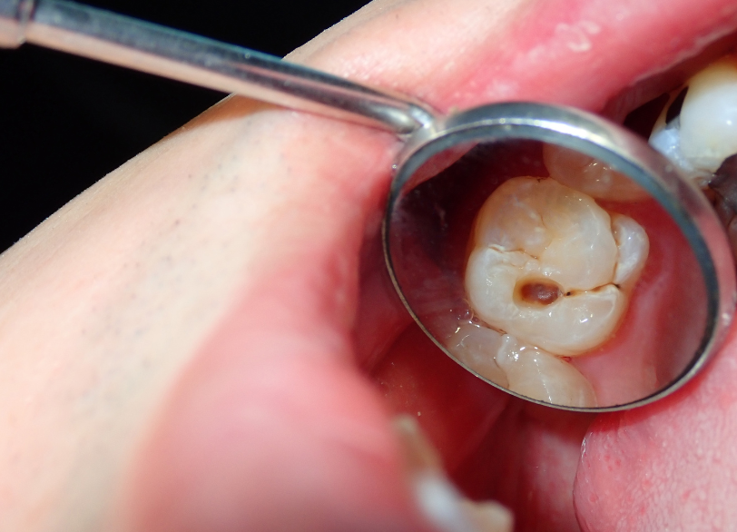 なぜ虫歯はできるのか｜おひさま歯科