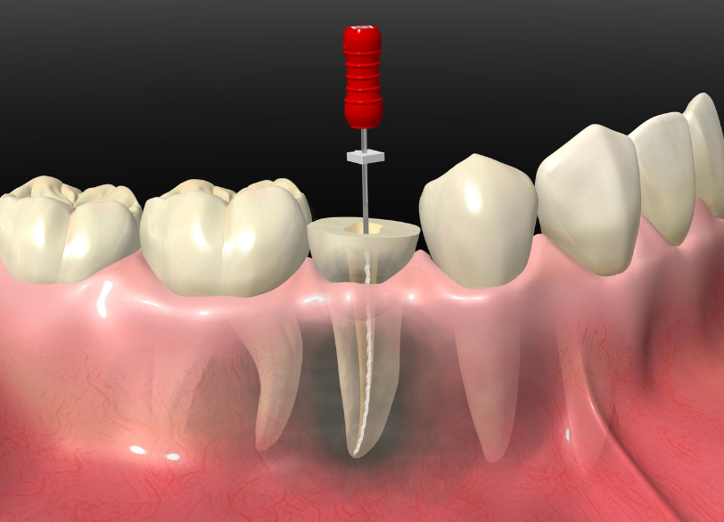 根管治療｜おひさま歯科
