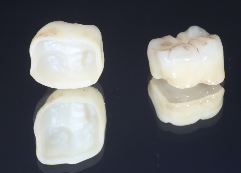 セラミック｜おひさま歯科