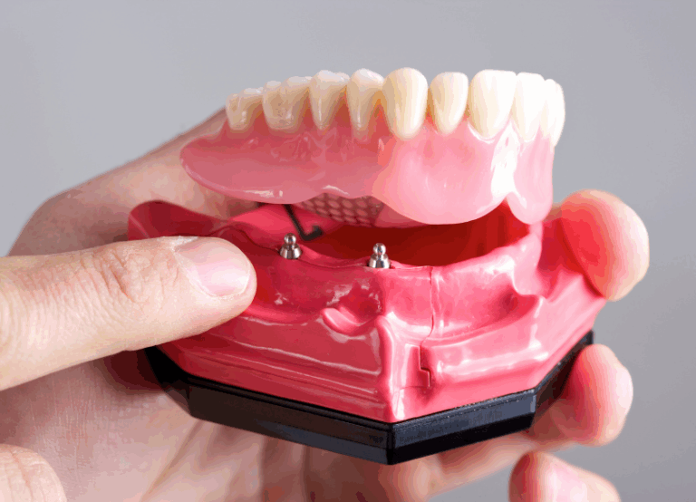 インプラントオーバーデンチャー｜おひさま歯科