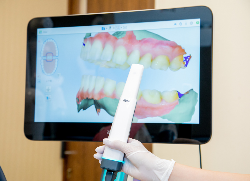 口腔内スキャナー｜おひさま歯科