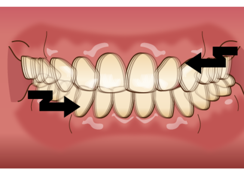 歯ぎしり｜おひさま歯科