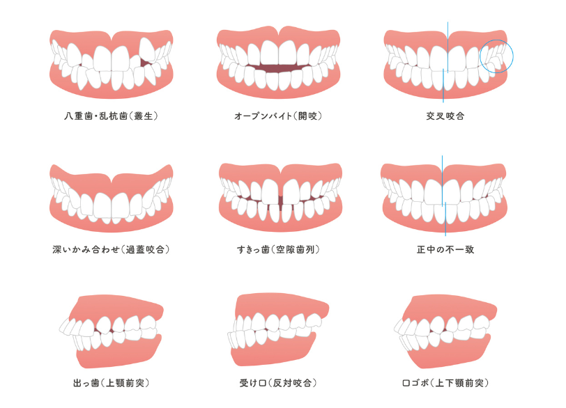 不英咬合｜おひさま歯科