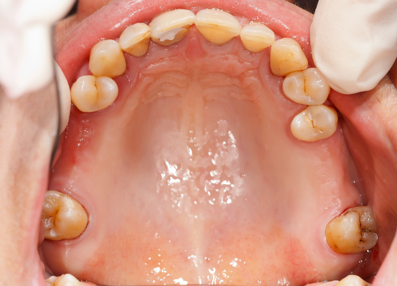 歯を失ったまま放置｜おひさま歯科
