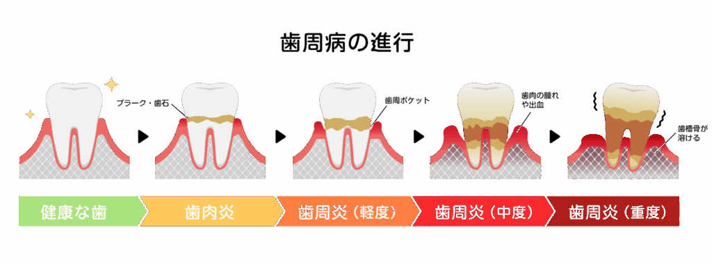 歯周病の進行｜おひさま歯科