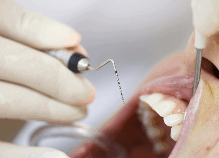 歯周ポケット検査｜おひさま歯科