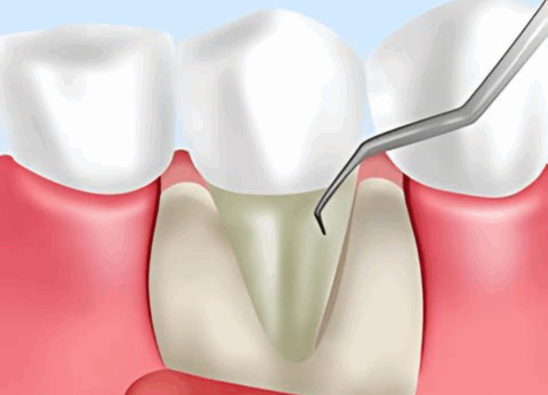 フラップ手術｜おひさま歯科