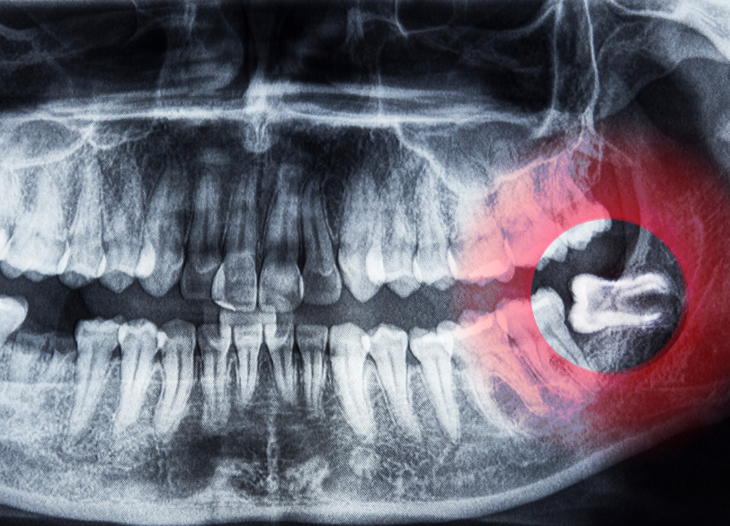 親知らずとは｜おひさま歯科