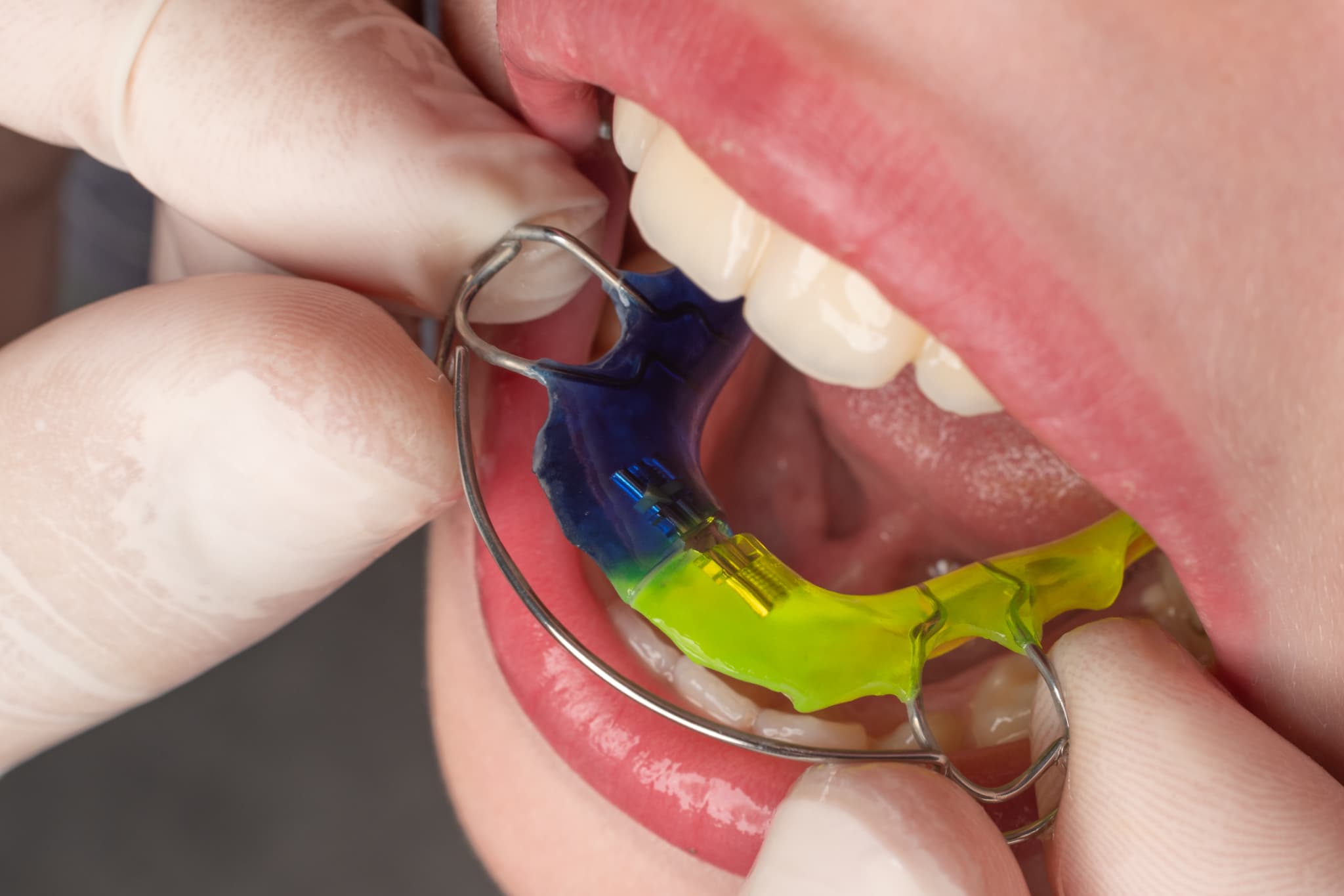 床矯正で痛みを感じるため装置の位置とフィット感を確認する様子