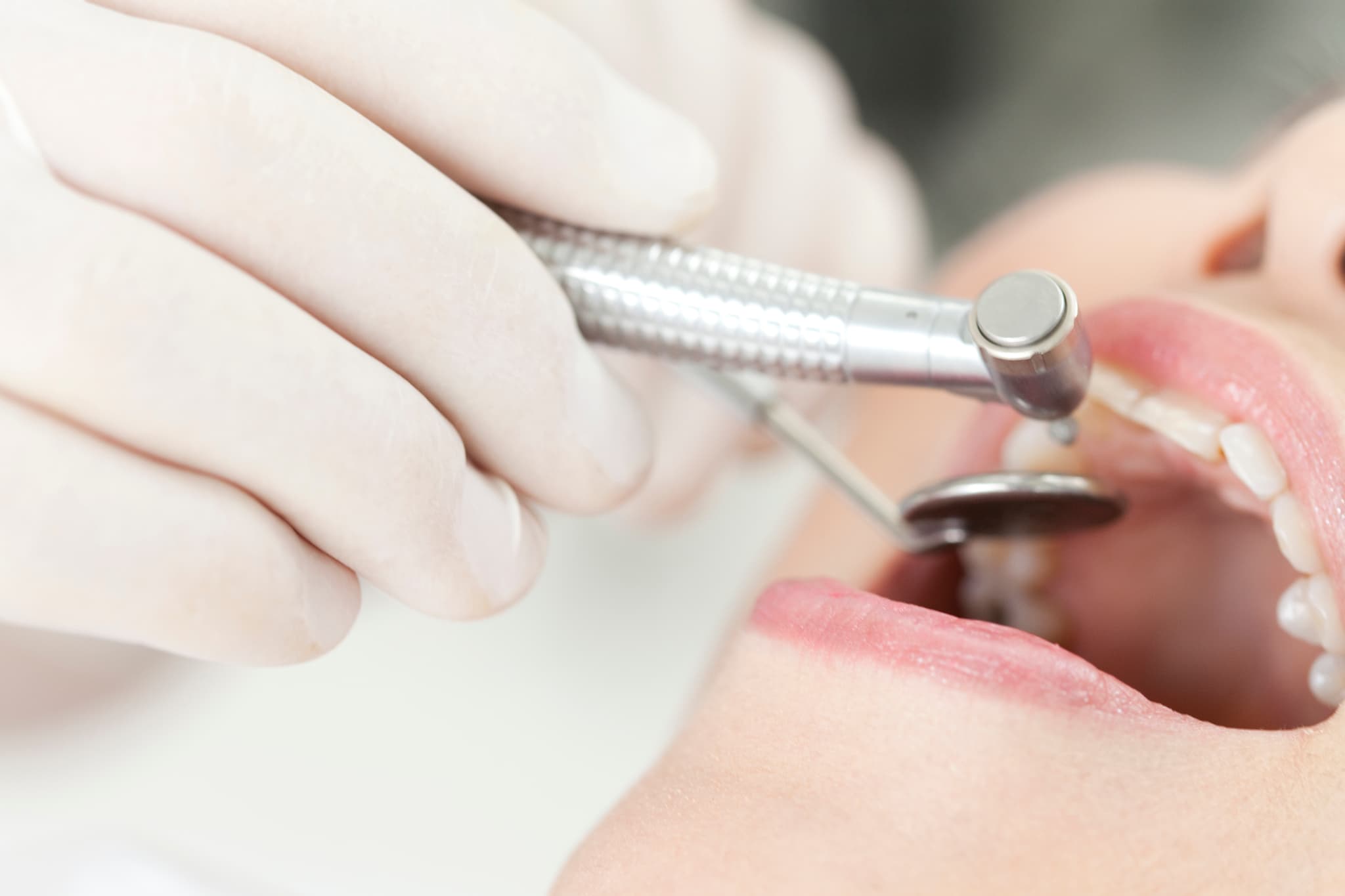 根管治療のために虫歯を治療する様子