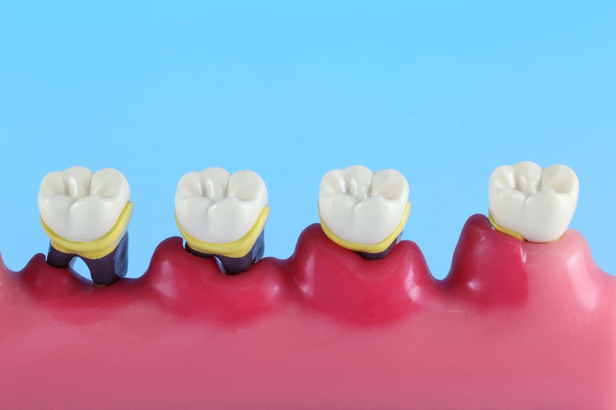 歯周病が進行していく様子の模型