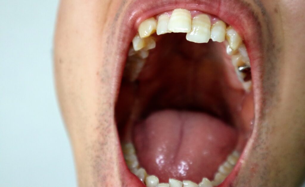 奥歯を失い、乱れた歯並びの男性