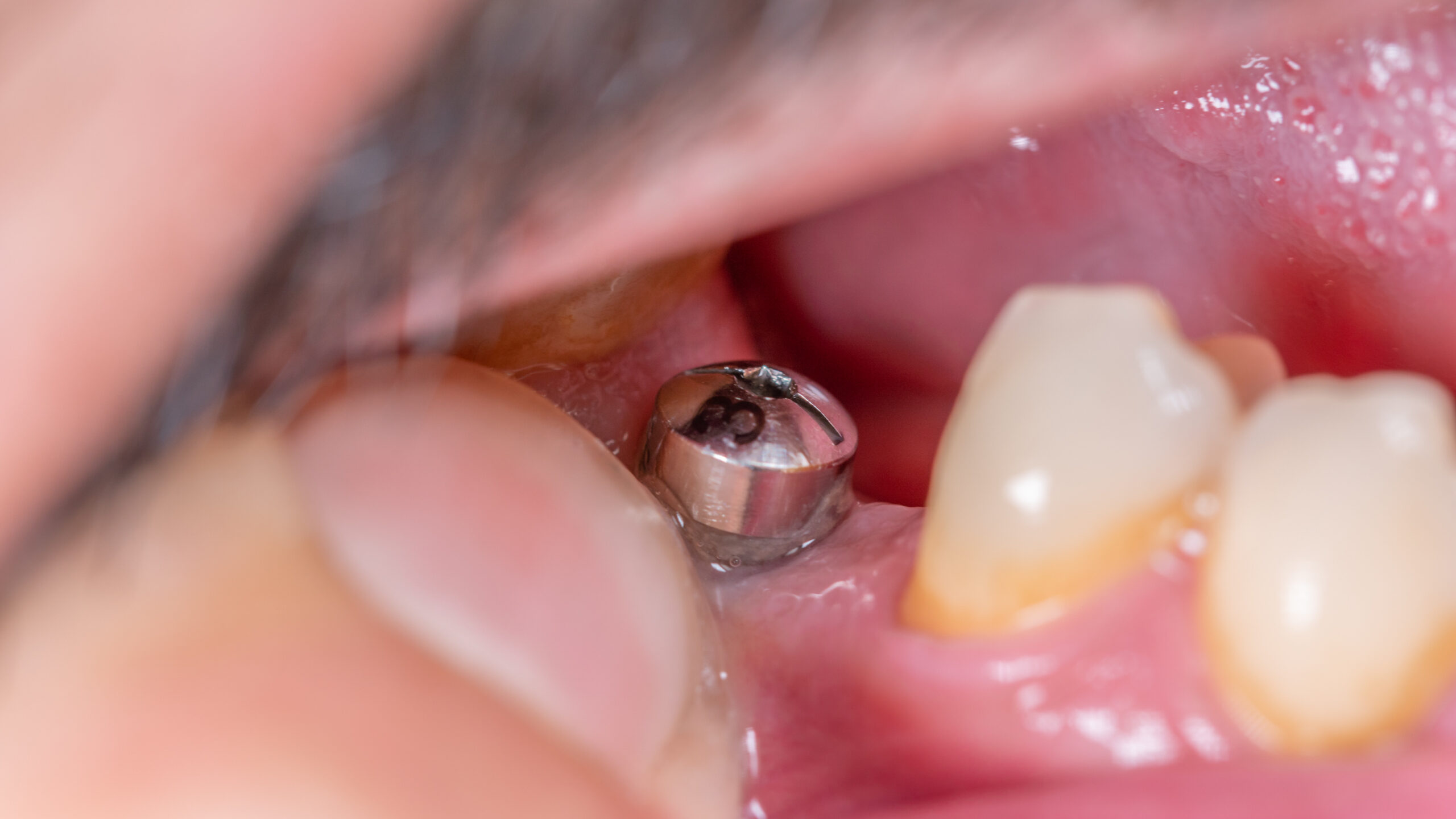 奥歯にインプラントをしている男性