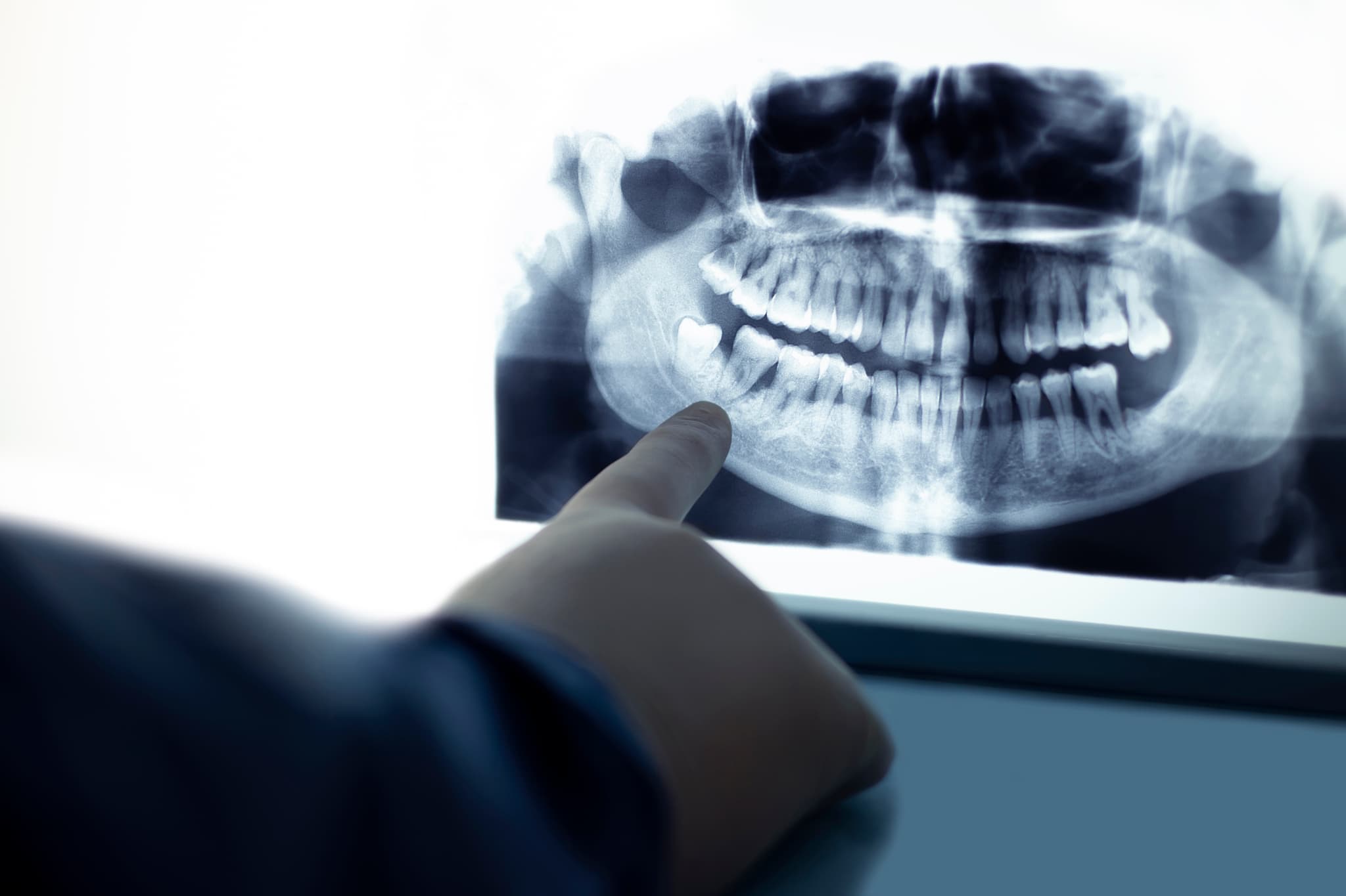 親知らずが生えてきたため歯科医院で診察してもらう様子