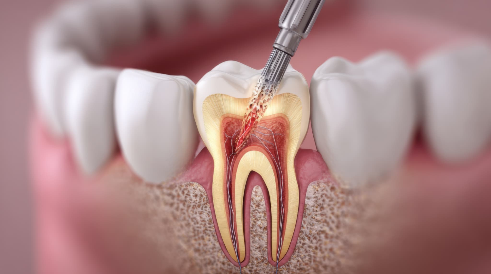 根管治療の様子