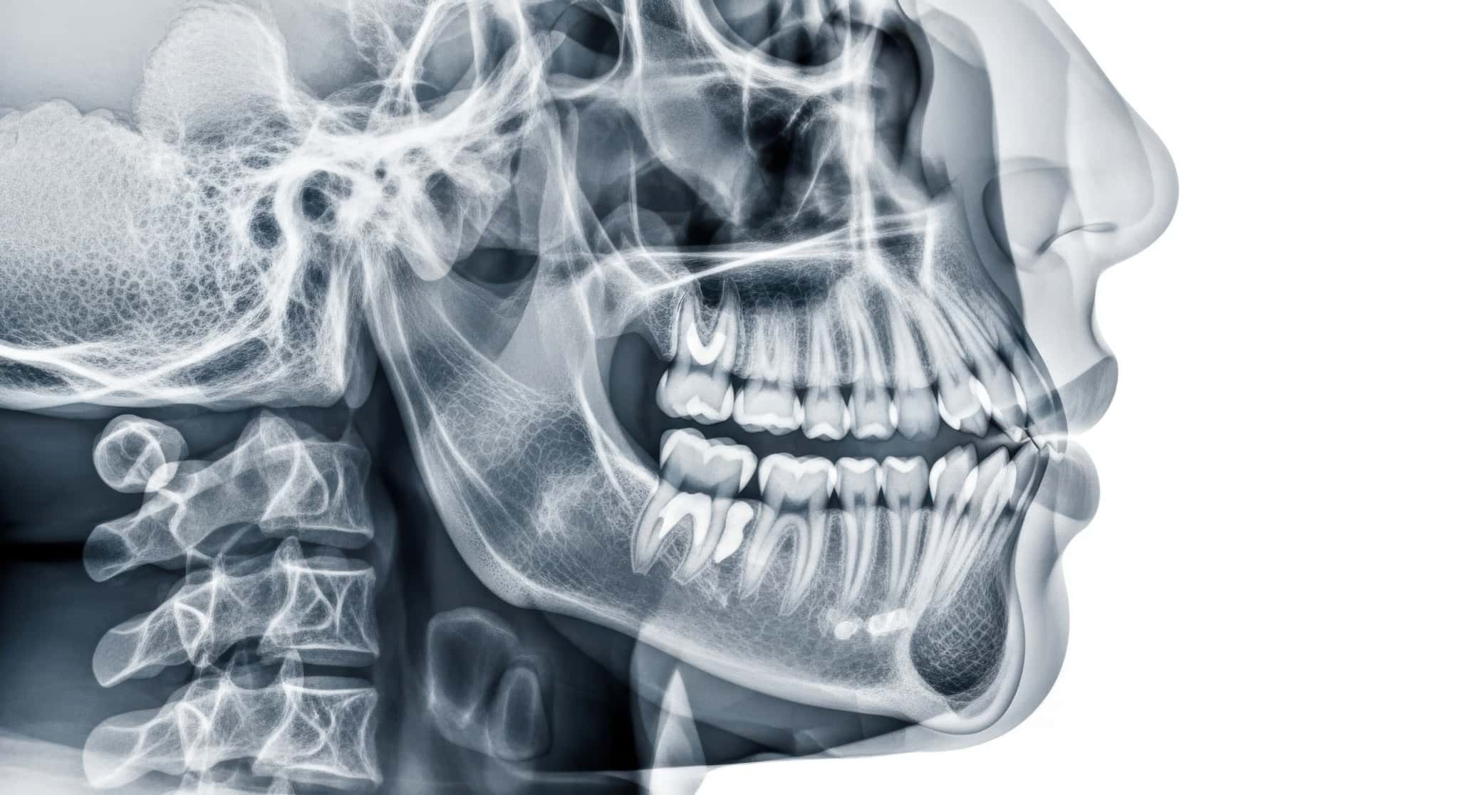 親知らずが生えるためのスペースが不足していることが分かる顎の透過図