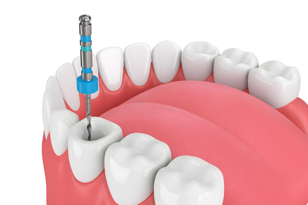 根管治療の様子