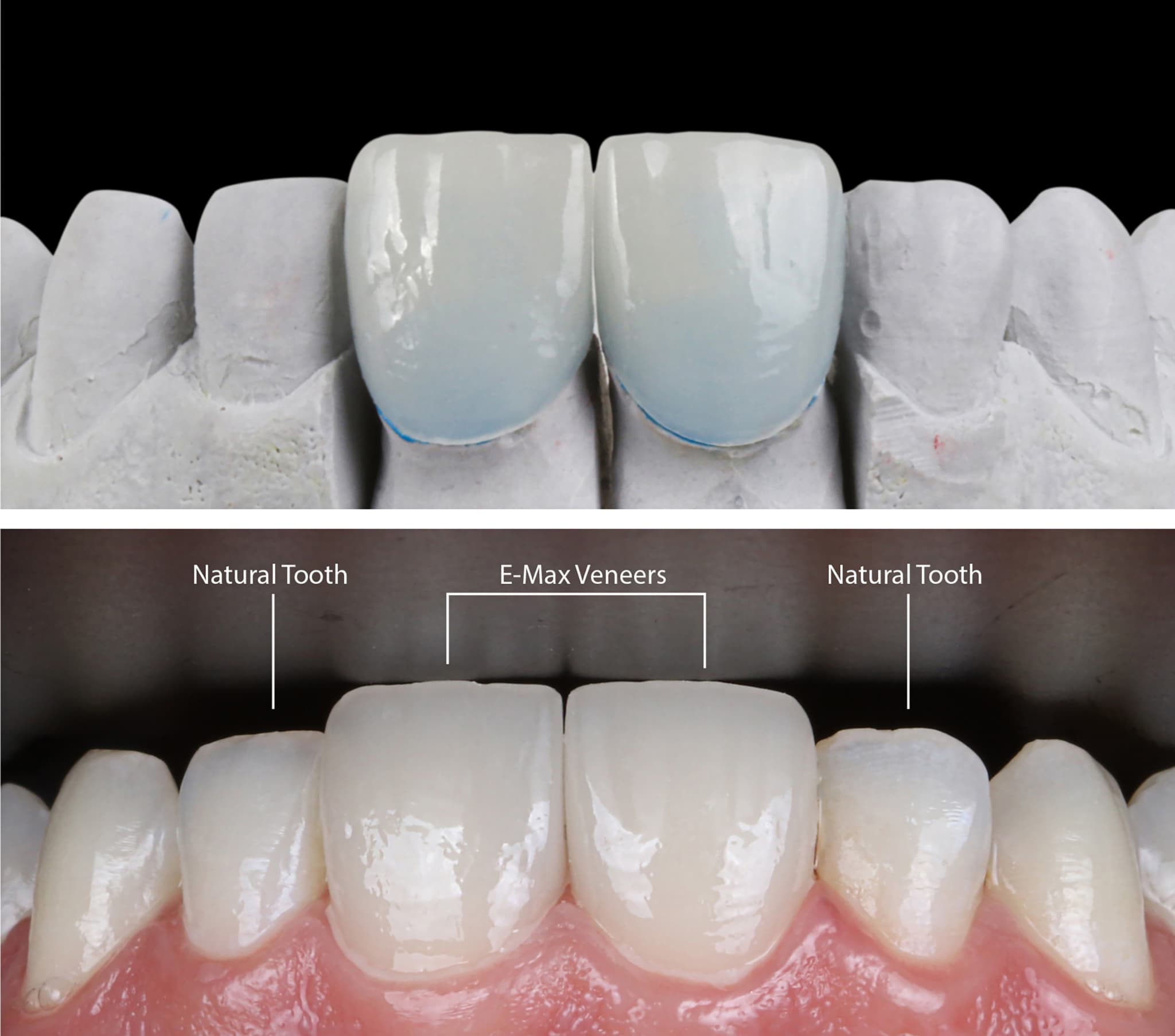 e-maxで前歯を施術したイメージ